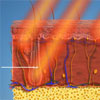 diode-laser